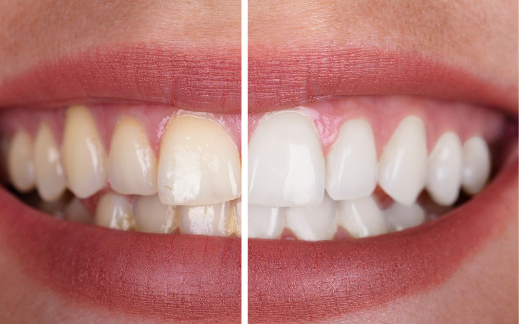 Teeth Whitening